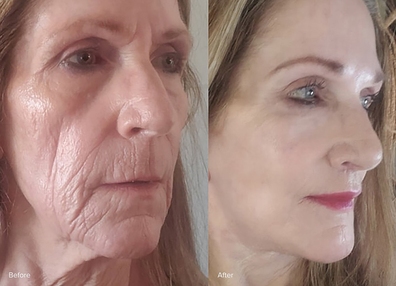 Before and after skin treatment comparison.