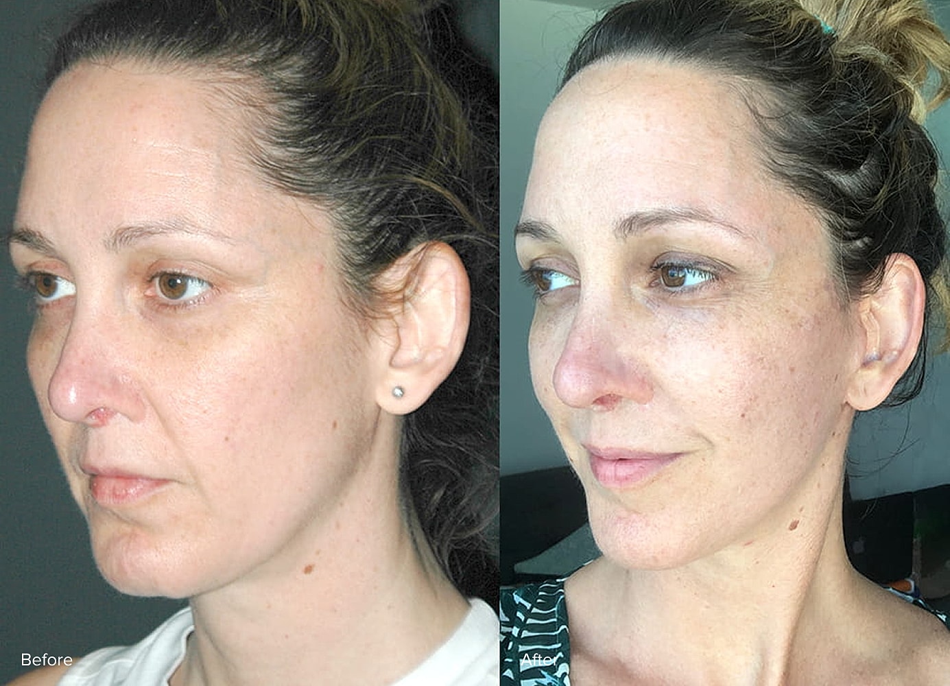 Before and after skin treatment comparison.