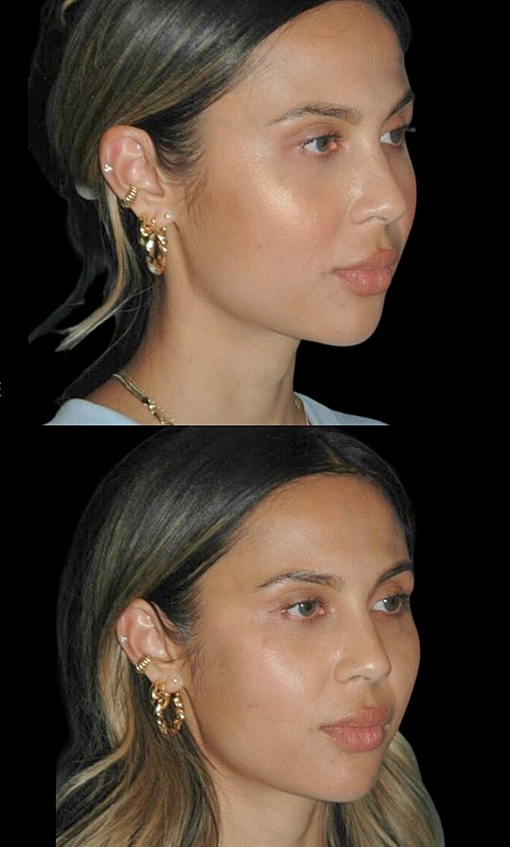 Profile view of woman with earrings.