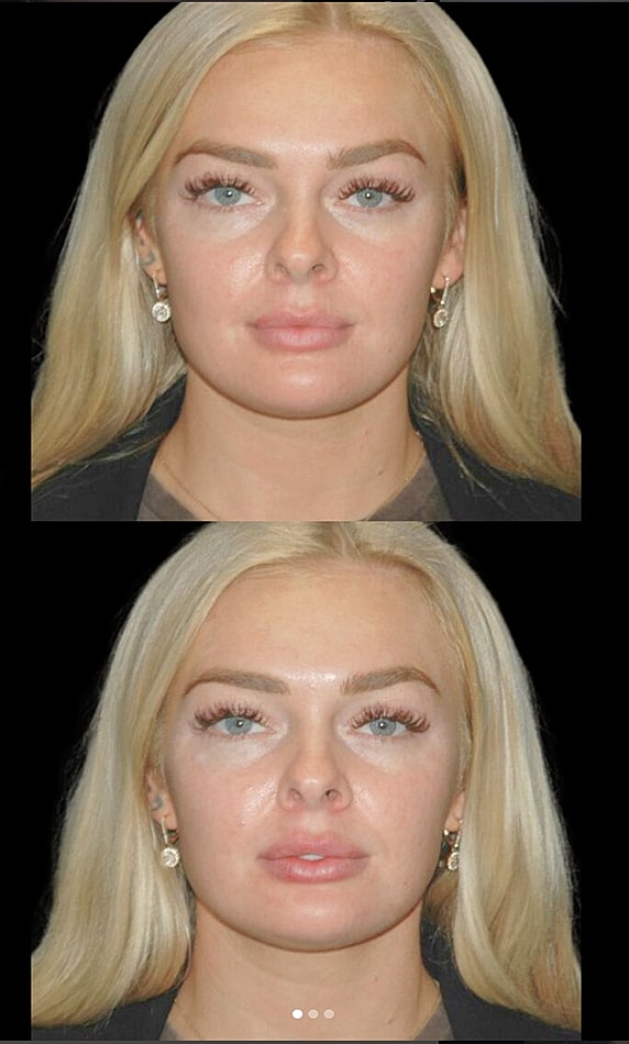 Before and after cosmetic procedure comparison.