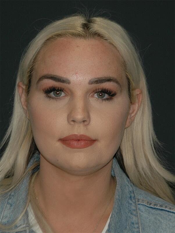 Jawline Contouring Before & After