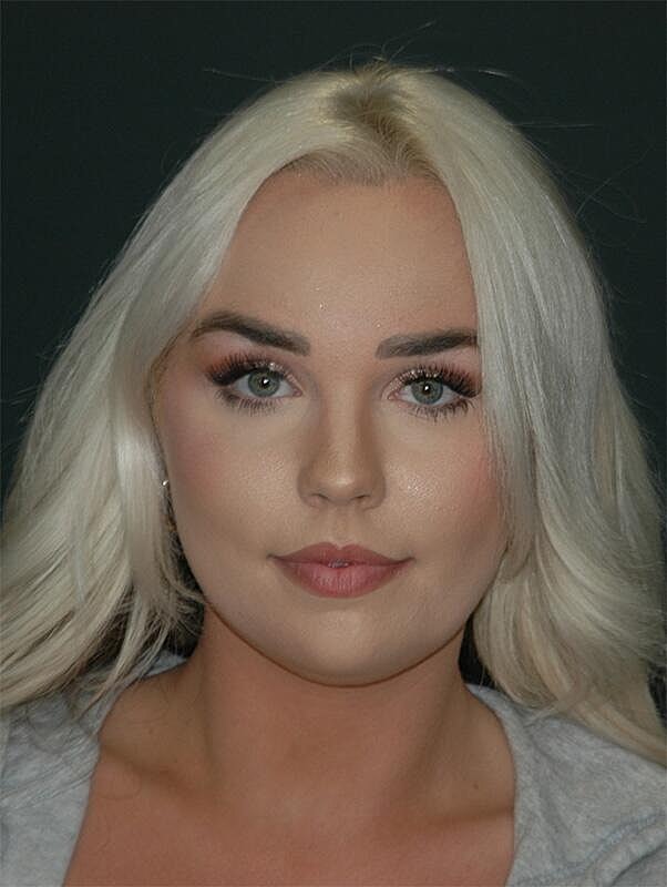 Jawline Contouring Before & After