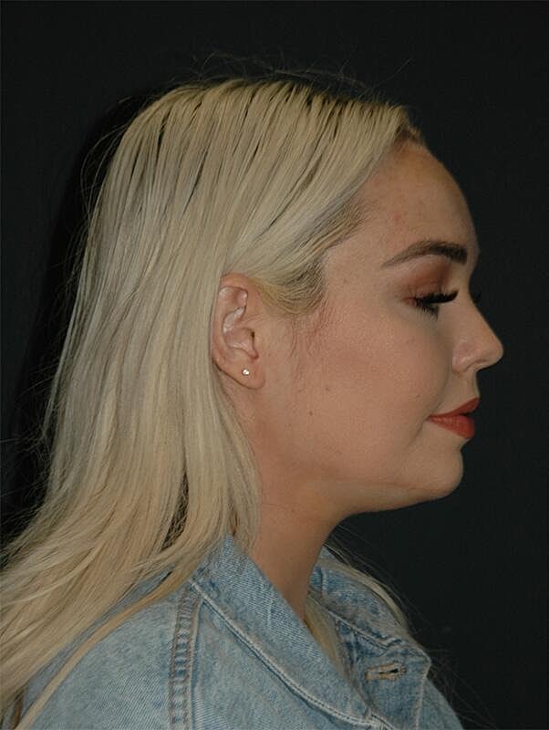 Jawline Contouring Before & After