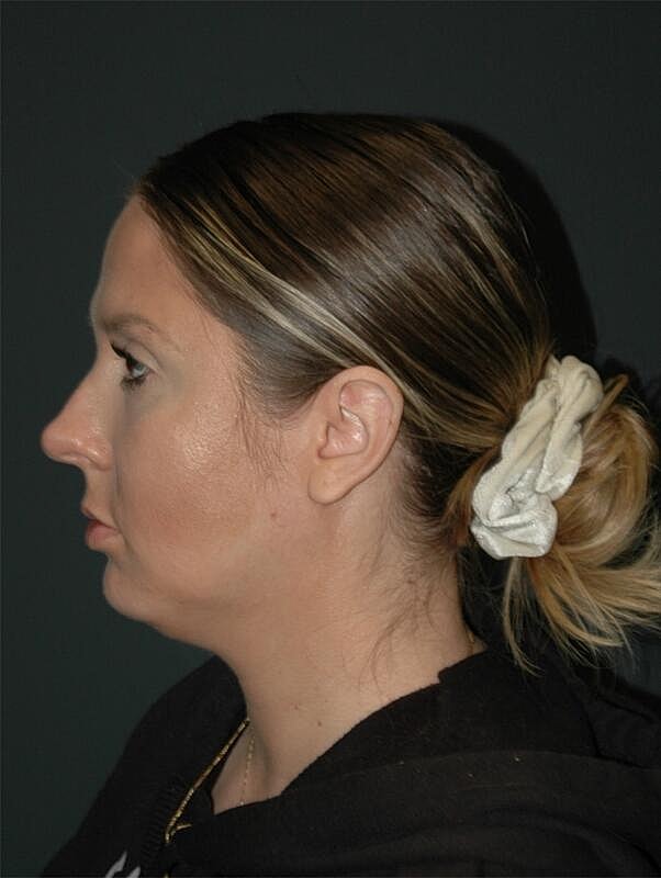 Jawline Contouring Before & After