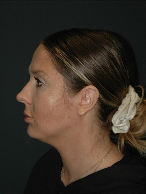 Jawline Contouring Before & After