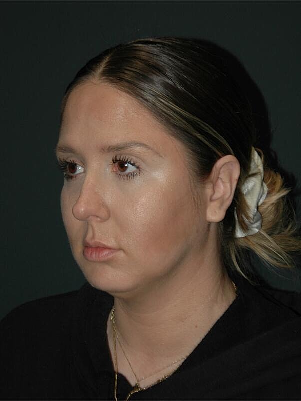 Jawline Contouring Before & After