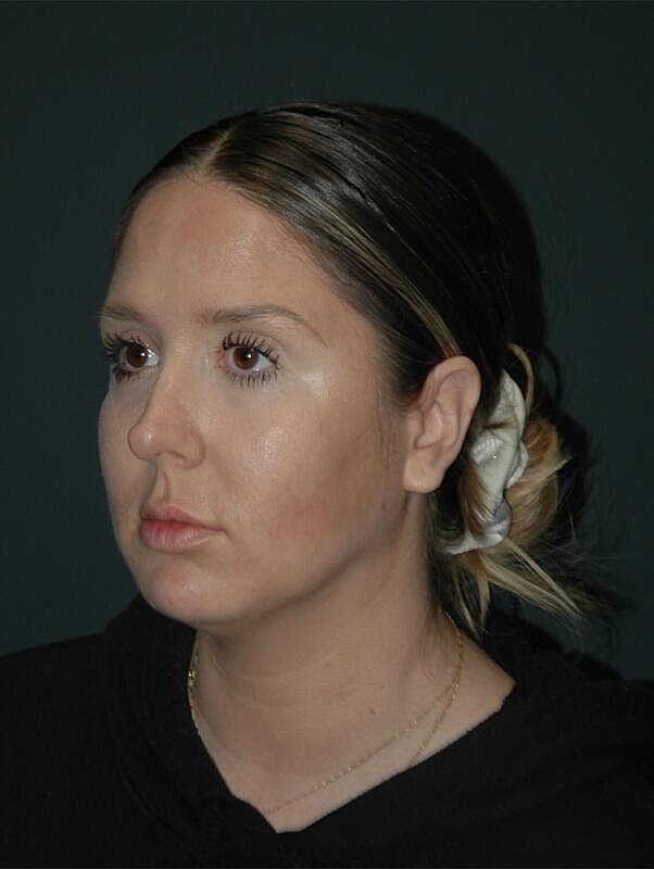 Jawline Contouring Before & After