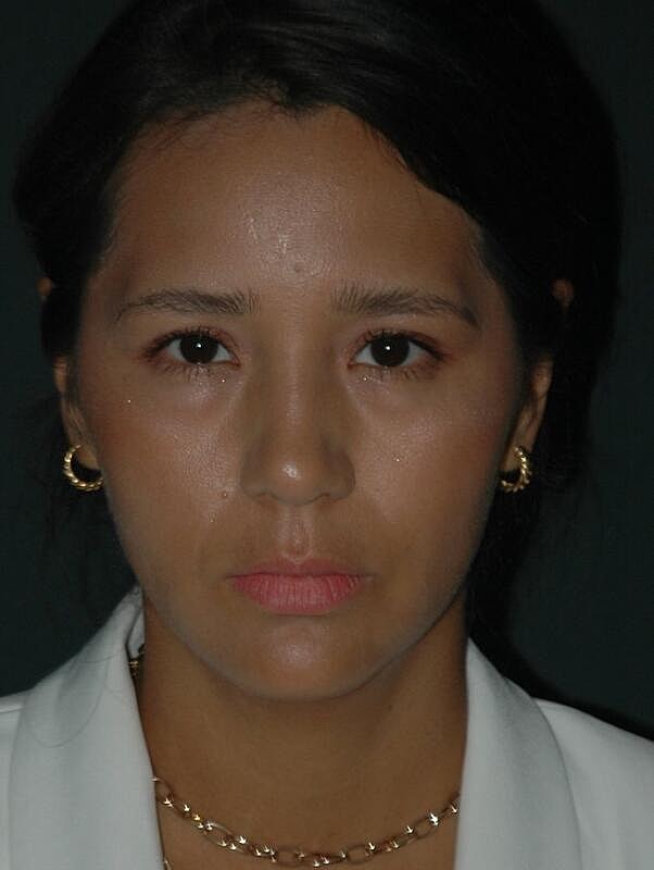 Jawline Contouring Before & After