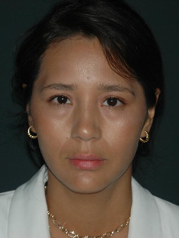 Jawline Contouring Before & After
