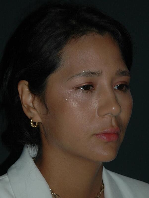 Jawline Contouring Before & After