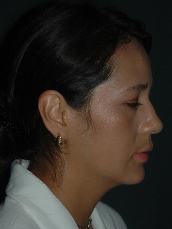 Jawline Contouring Before & After