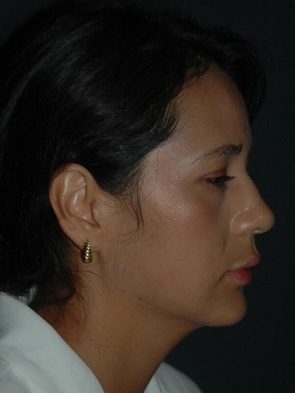 Jawline Contouring Before & After