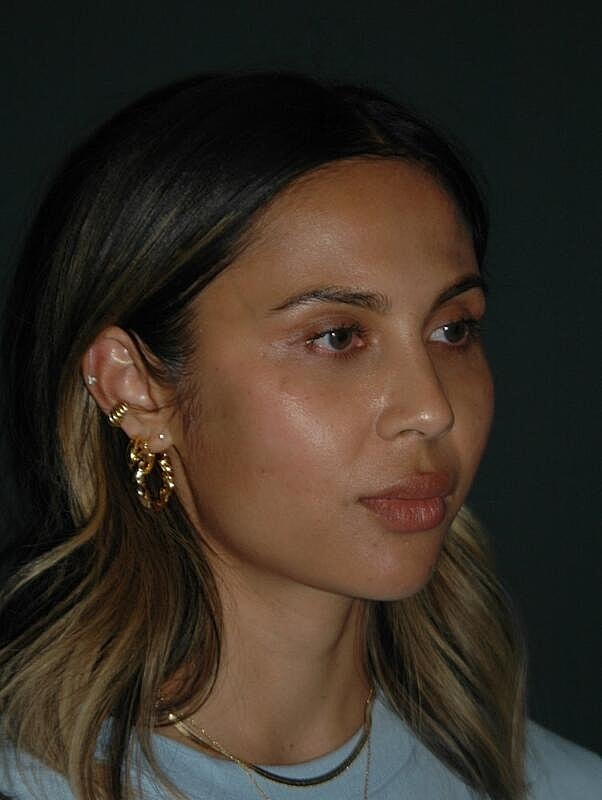 Jawline Contouring Before & After