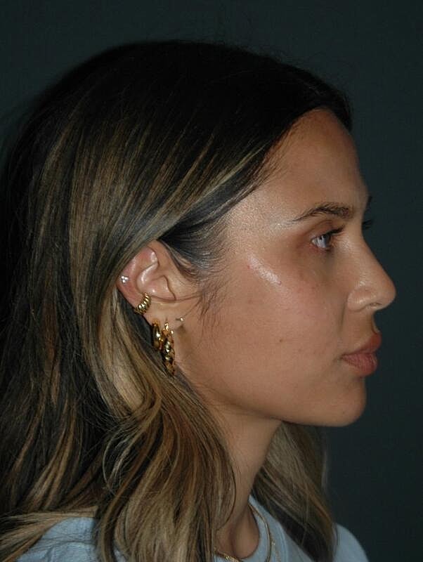 Jawline Contouring Before & After