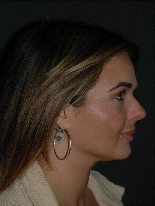 Jawline Contouring Before & After