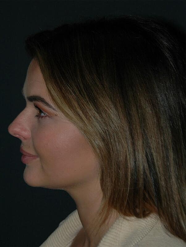 Jawline Contouring Before & After