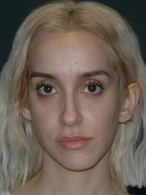 Jawline Contouring Before & After
