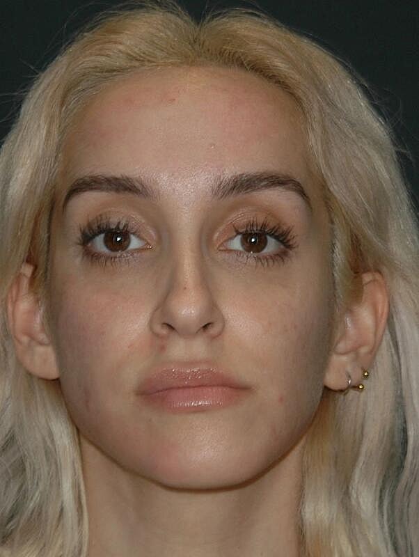 Jawline Contouring Before & After
