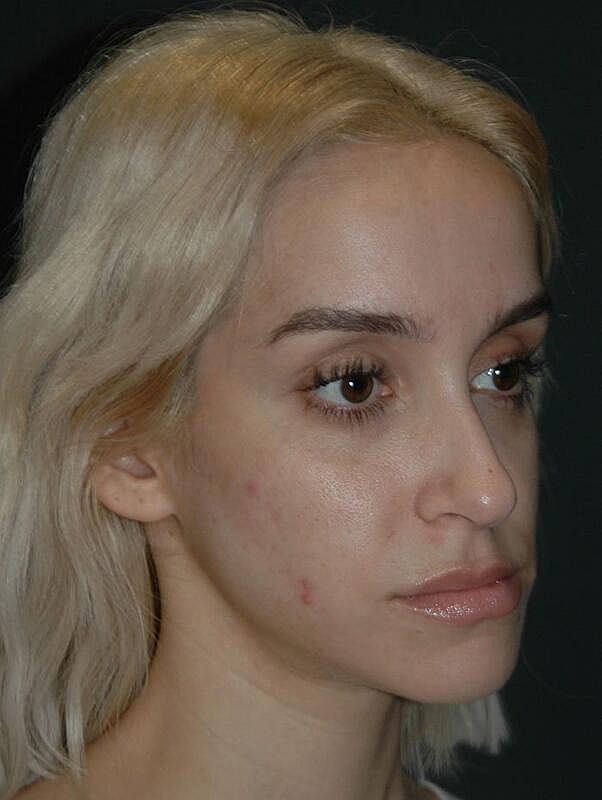 Jawline Contouring Before & After