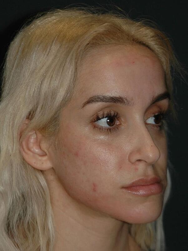 Jawline Contouring Before & After