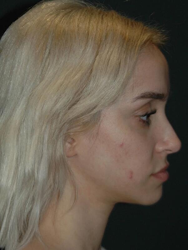 Jawline Contouring Before & After