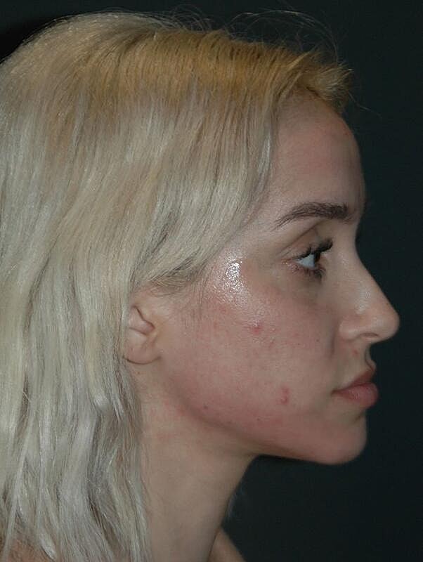 Jawline Contouring Before & After