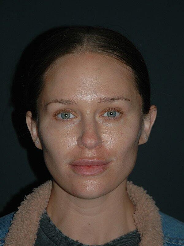 Jawline Contouring Before & After