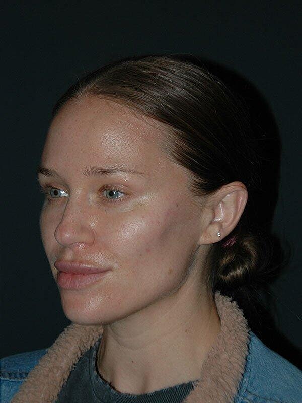 Jawline Contouring Before & After