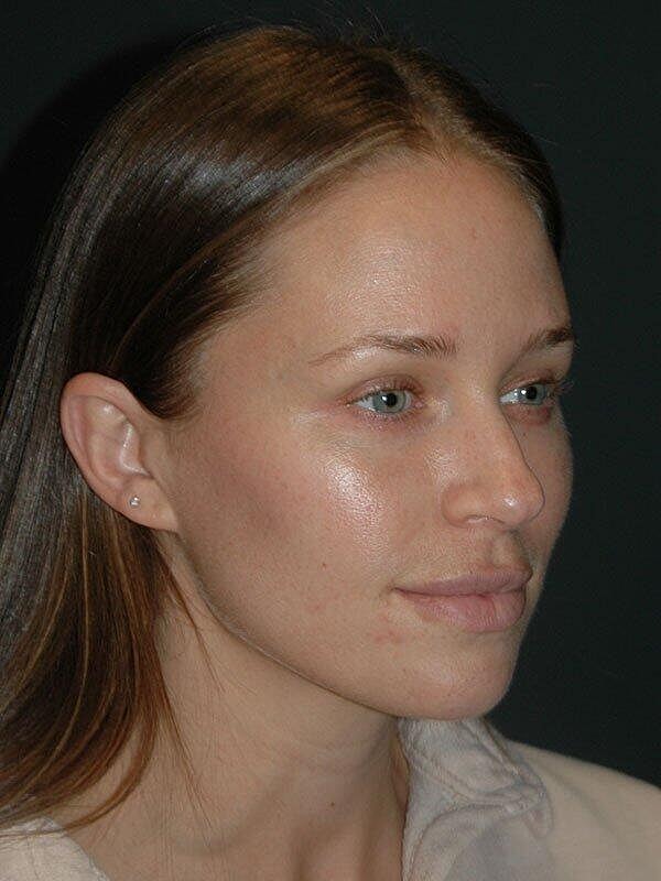 Jawline Contouring Before & After