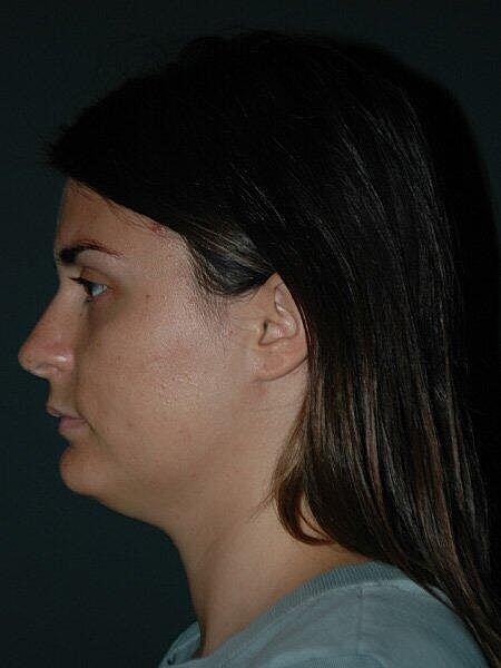 Facial Liposuction Before & After