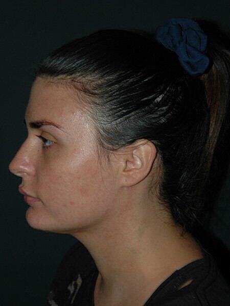 Facial Liposuction Before & After