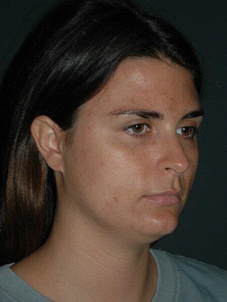 Facial Liposuction Before & After
