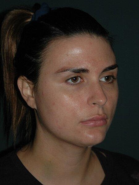 Facial Liposuction Before & After
