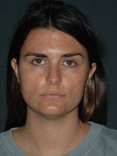 Facial Liposuction Before & After