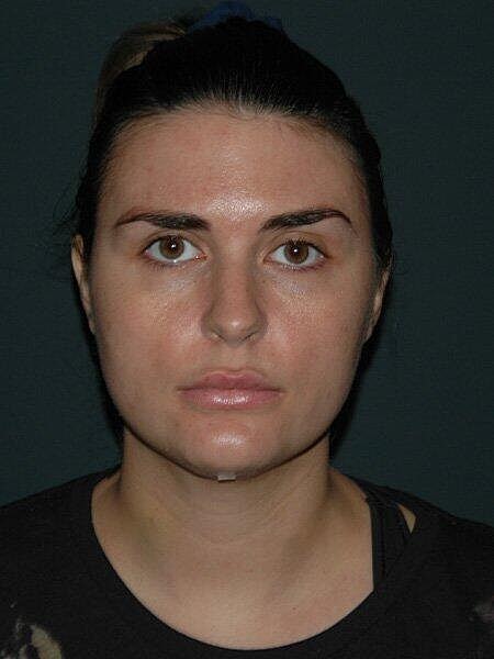 Facial Liposuction Before & After