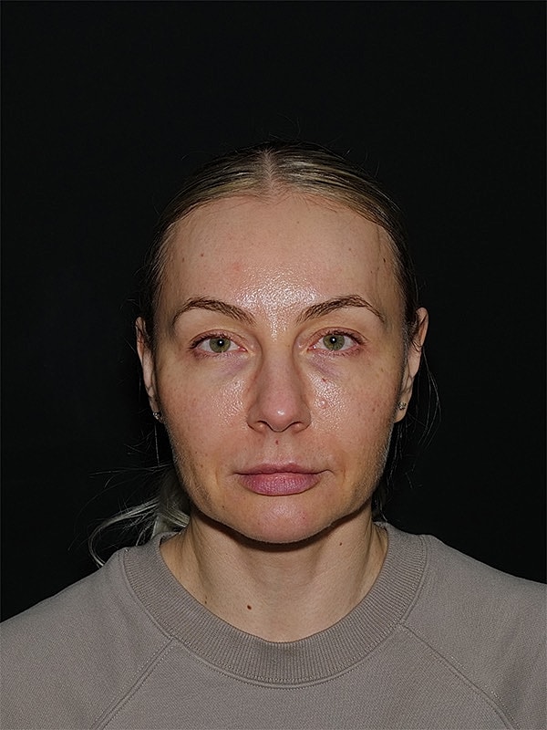 Fat Transfer Before & After