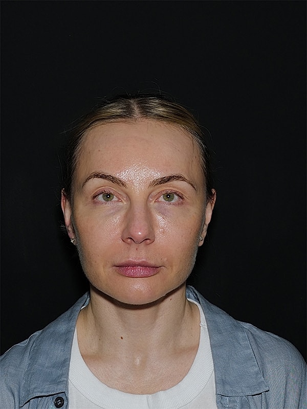 Fat Transfer Before & After