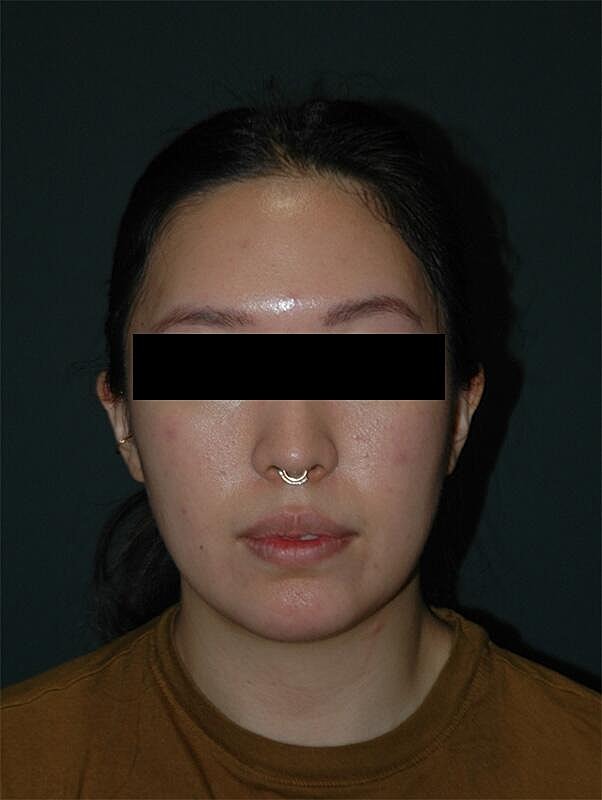 Chin Implant Before & After