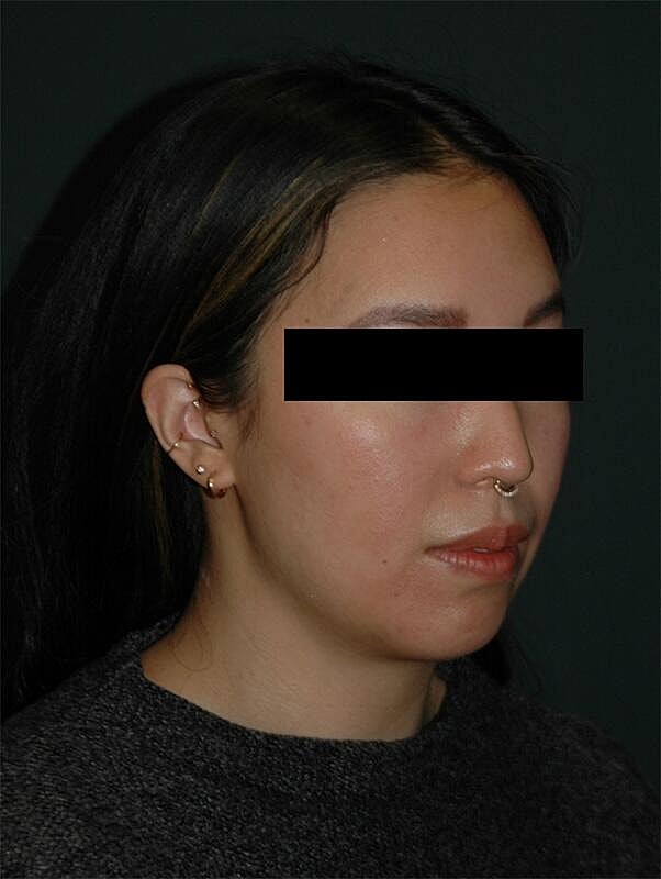 Chin Implant Before & After