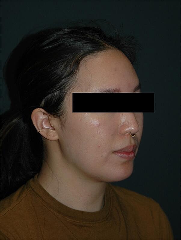 Chin Implant Before & After