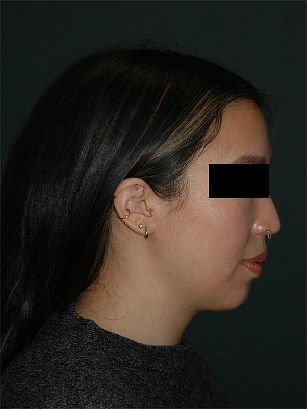 Chin Implant Before & After