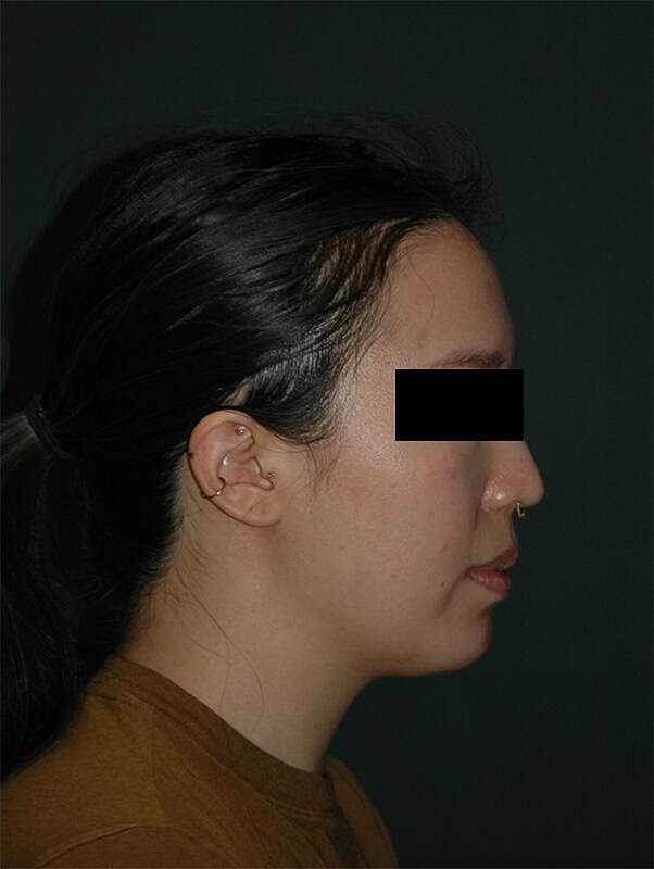 Chin Implant Before & After
