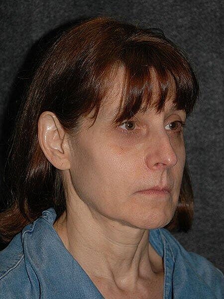Chin Implant Before & After