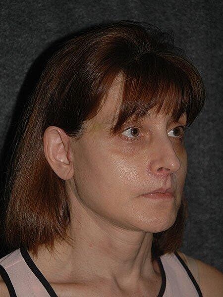 Chin Implant Before & After