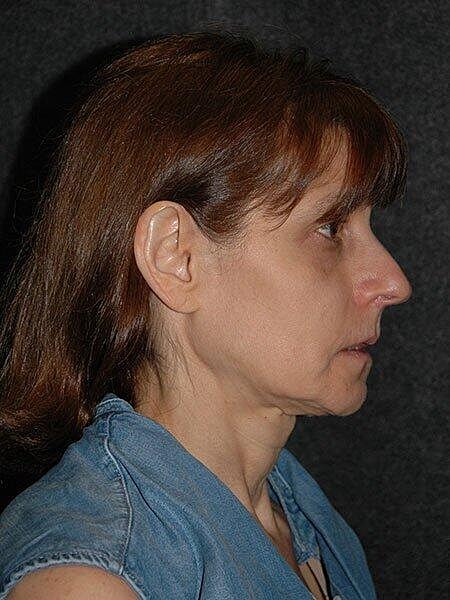 Chin Implant Before & After