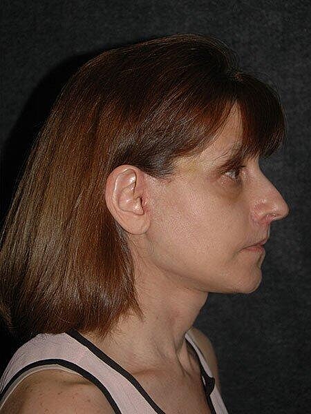 Chin Implant Before & After
