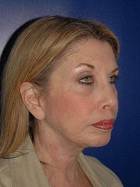 Chin Implant Before & After
