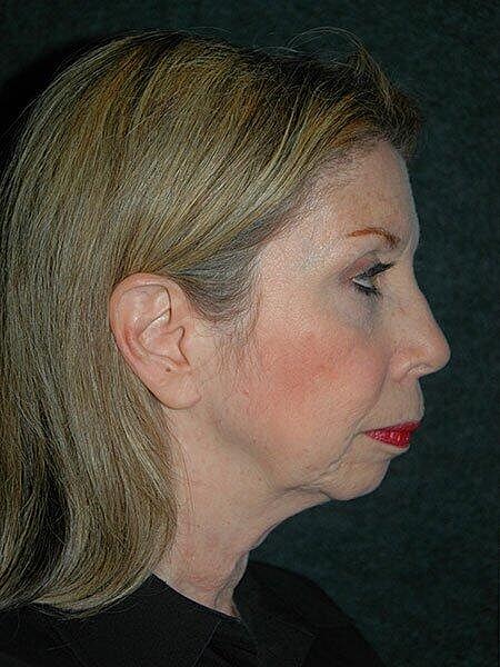 Chin Implant Before & After