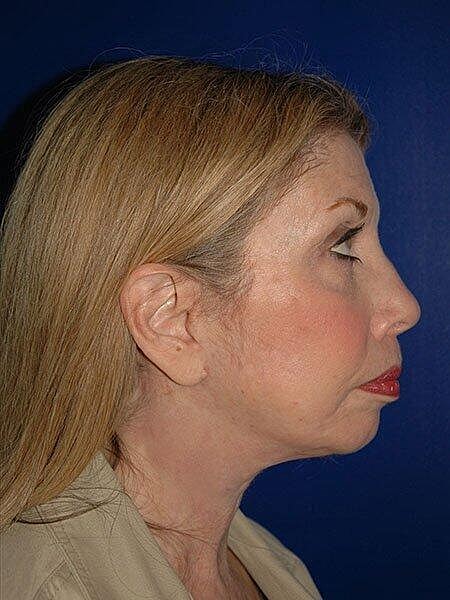 Chin Implant Before & After