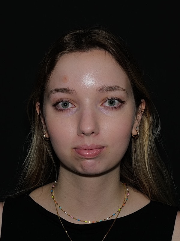 Chin Implant Before & After